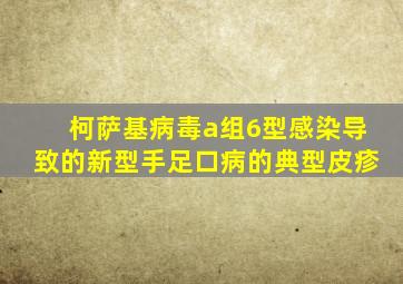 柯萨基病毒a组6型感染导致的新型手足口病的典型皮疹